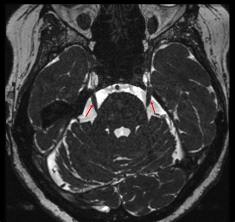 MRI of the trigeminal nerve : r/Radiology