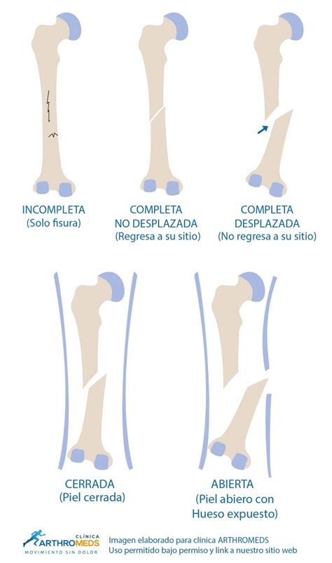 Como curar una fractura de hueso. Lima Perú