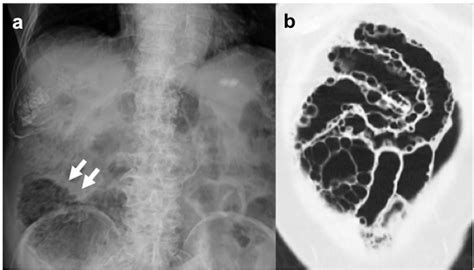 Figure 1 from Diagnostic laparoscopy for pneumatosis intestinalis in a very elderly patient: A ...