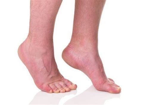 ANKLE EQUINUS - CAUSES AND TREATMENT