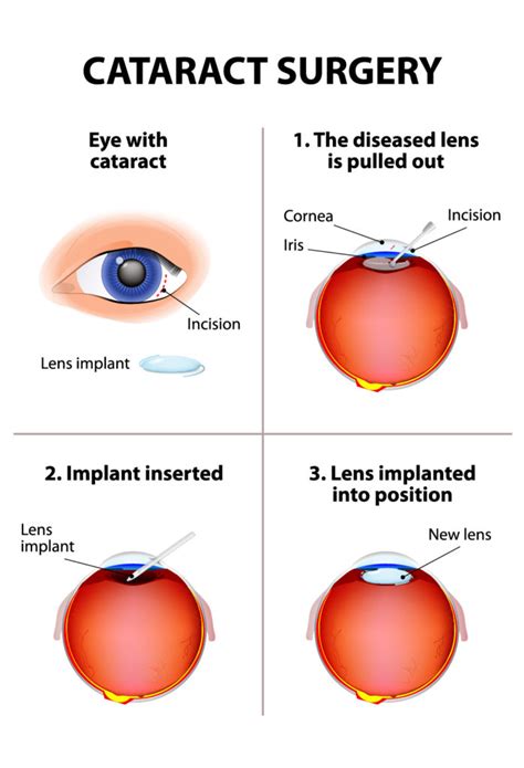 Cataract Surgery - PghEyeMeds