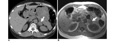 33-year-old man with adrenal adenoma. A. Transverse unenhanced CT image ...