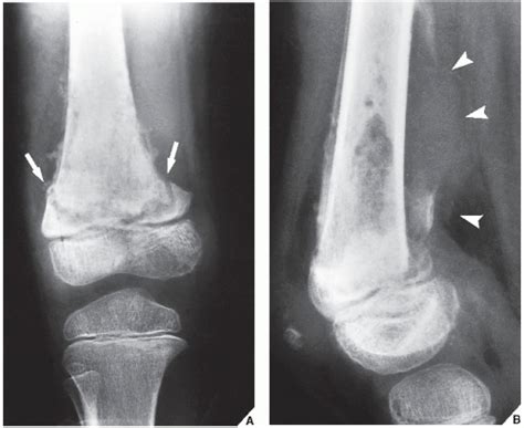 Osteomyelitis, Infectious Arthritis, and Soft-Tissue Infections ...