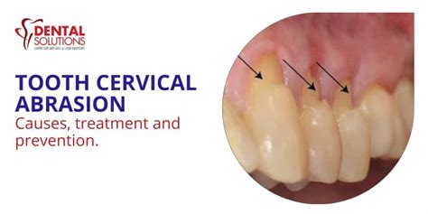 Tooth Cervical Abrasion, Causes, Treatment and prevention 1 - Best Dental Clinic In Bangalore ...