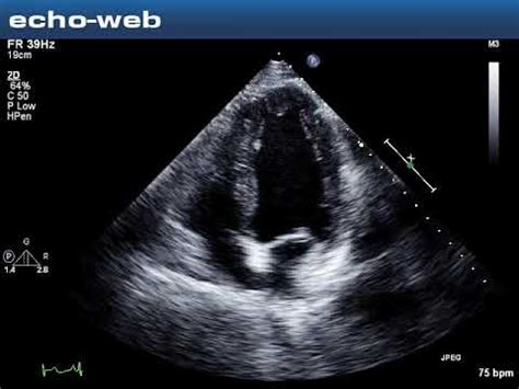 The EchoWeb - Patient Diagnosed with LV Diastolic Dysfunction and Reduced EF - YouTube