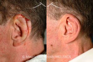 New York Facial Plastic Surgery Moh's Reconstruction Of Ears Before and After Pictures