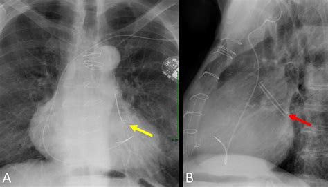 Amulet Left Atrial Appendage Closure Device