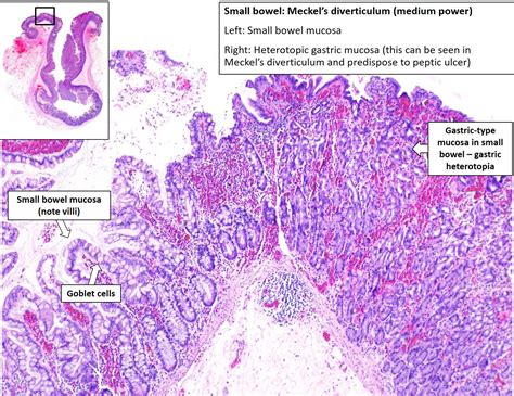 Intestine – Meckel's Diverticulum – NUS Pathweb :: NUS Pathweb