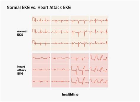 Mengenal Heart Rate, Apa itu ECG/EKG – WIA Journal