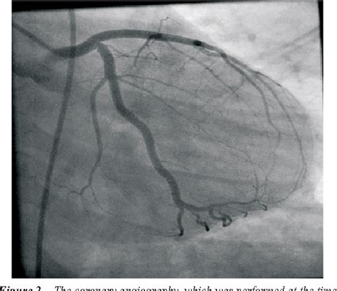 Figure 2 from The Allergic Angina Syndrome in Naproxen Sodium Induced ...