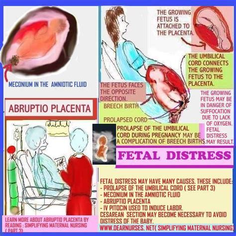 Dear Nurses: FETAL DISTRESS