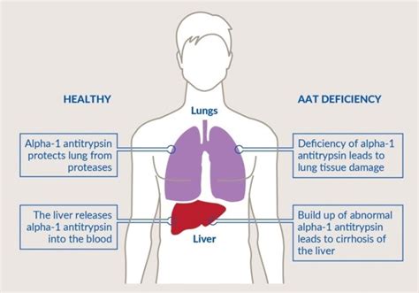 Alpha-1 antitrypsin deficiency and lung disease – what it means for my patient during the COVID ...