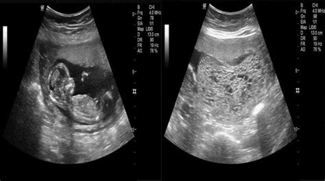 Ultrasound image showing snowstorm pattern of complete hydatidiform... | Download Scientific Diagram