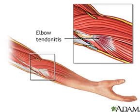 13 Causes for Upper Arm Pain: Is it from my shoulder, my neck, or a ...