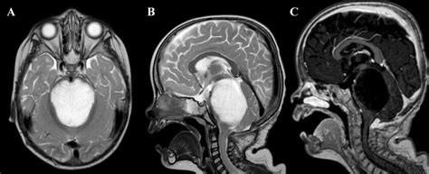 Diagnostic MRI of large pontine tumor. A T2-weighted axial images... | Download Scientific Diagram