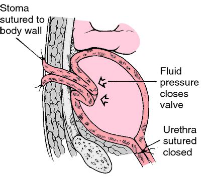 Kock pouch | definition of Kock pouch by Medical dictionary