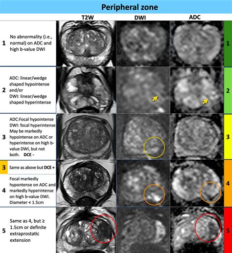 The Radiology Assistant : Prostate Cancer - PI-RADS v2.1