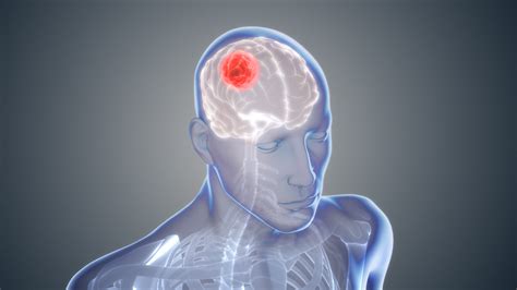 Glioblastoma: The Cancer of Brain - Scientific Animations