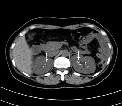 Non-contrast computed tomography shows medullary nephro | Open-i