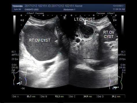 Ultrasound Video showing a Chocolate ovarian cyst and a hemorrhagic ...