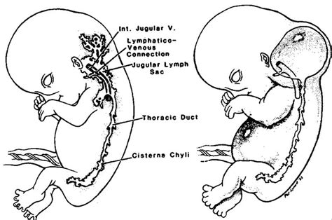 CYSTIC HYGROMA - www.medicoapps.org