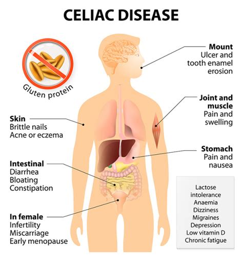 Celiac Disease Symptoms Checklist | Celiac Disease Symptoms