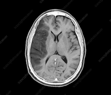 Stroke Brain Mri