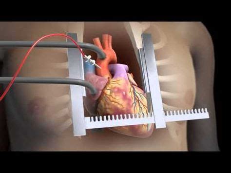 Sternotomy - Open Heart Surgery 3D Animation - YouTube | Open heart surgery, Heart surgery ...