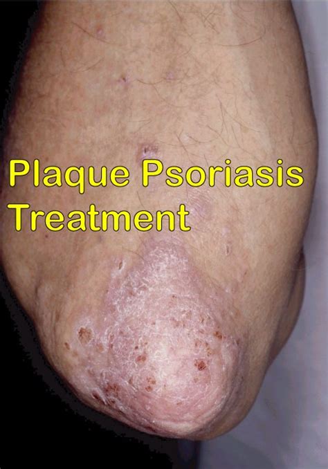 5 Best Plaque Psoriasis Treatment You Can Rely On - Disfreeskin