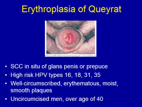 Erythroplasia Of Queyrat Pictures