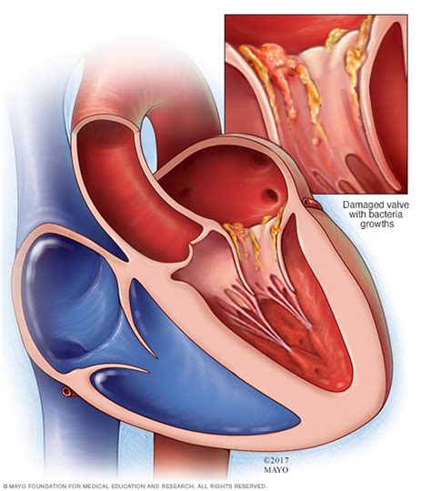 Endocarditis - Symptoms and causes - Mayo Clinic