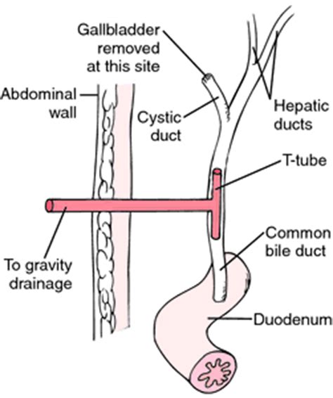 Cholecystectomy, laparoscopic | definition of Cholecystectomy, laparoscopic by Medical dictionary