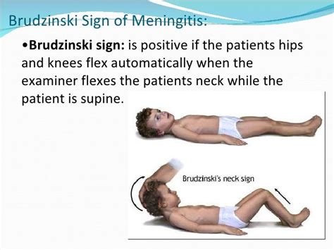 Short presentation version cns infections Lecture