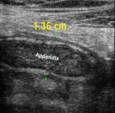 Appendicitis Ultrasound Criteria