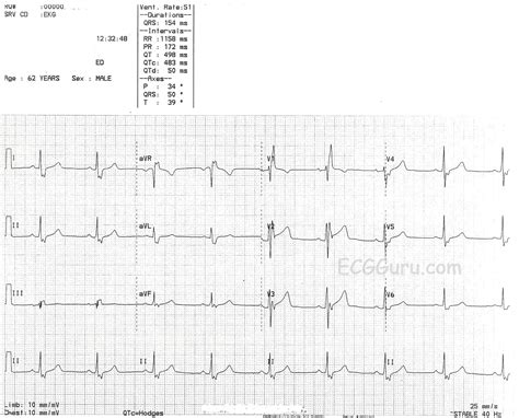 Right Bundle Branch Block | ECG Guru - Instructor Resources