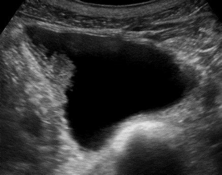 Empty Bladder Ultrasound