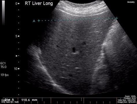 Normal Liver Ultrasound