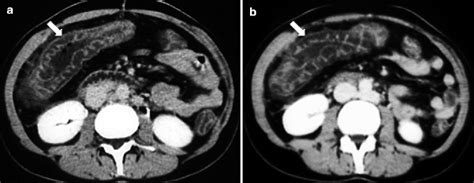 Ischemic Bowel Disease | Radiology Key