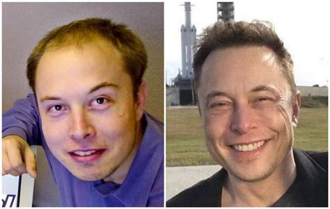 Elon Musk Hair Transplant Journey Step by Step