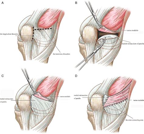 Medial Patellar Retinaculum Plasty Versus Medial Capsule Reefing for Patellar Subluxation in ...