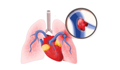 FlowTriever System Is a First-of-Its-Kind Treatment for Blood Clots