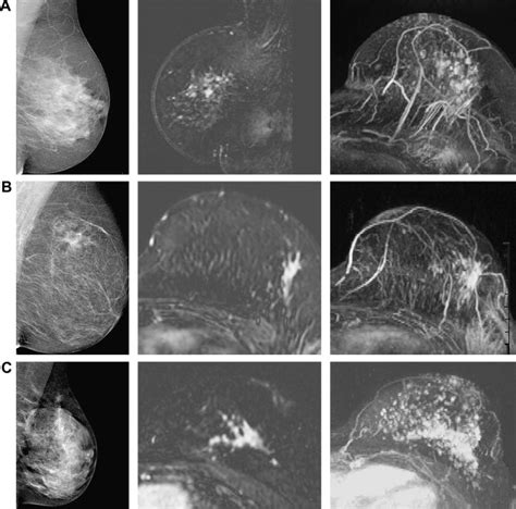 The Effectiveness of MR Imaging in the Assessment of Invasive Lobular ...