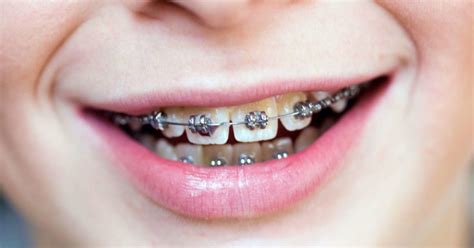 Do braces hurt? What to expect when you get braces