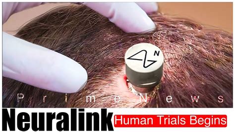 The Dawn of a New Era: Neuralink Begin Human Trials - YouTube