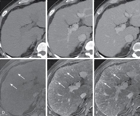 Imaging of the cirrhotic liver | Radiology Key