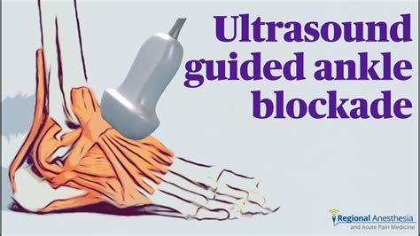 Ultrasound Guided Ankle Block - YouTube