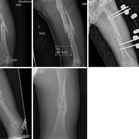 The treatment of a pediatric diaphyseal femoral fracture. Six-year-old... | Download Scientific ...