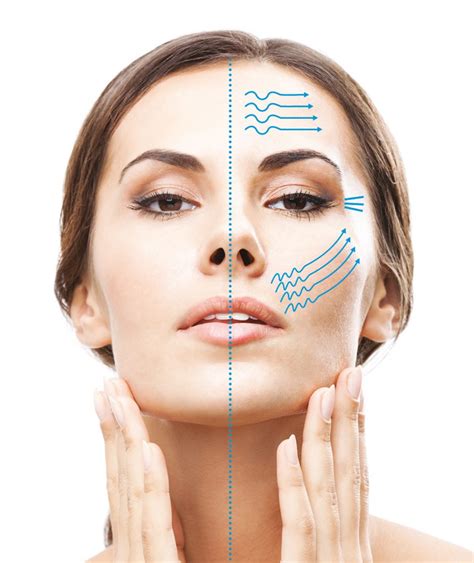 rf microneedling vs co2 laser vs Tixel – vivalaser for you for all for ...