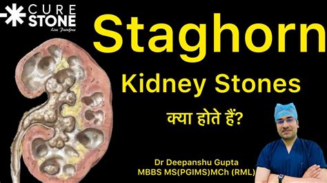 Staghorn Kidney Stones