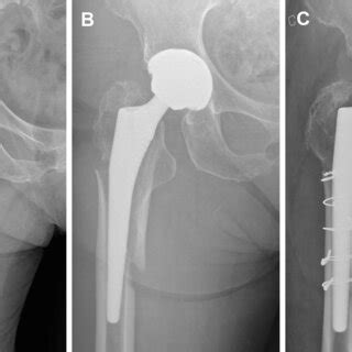 An 82-year-old woman underwent total hip arthroplasty due to ...